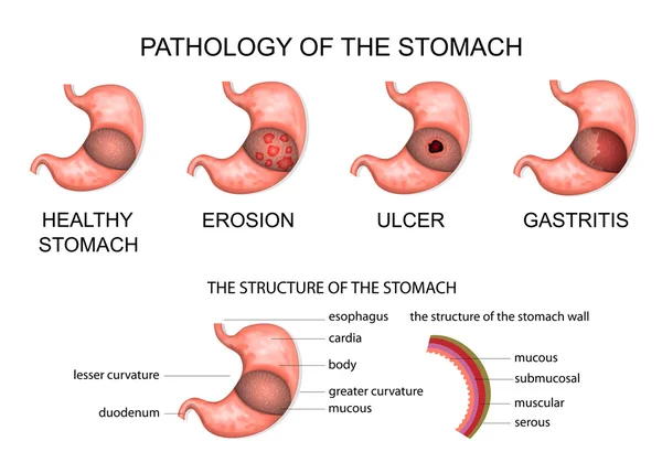 Patologia żołądka — Wektor stockowy