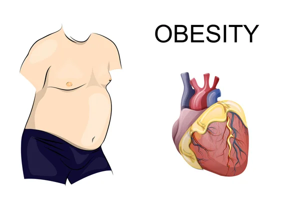 Obesity. body and heart — Stock Vector