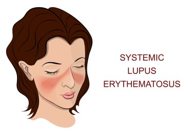 Lupus Erythematosus Premium Vector Download For Commercial Use Format Eps Cdr Ai Svg Vector Illustration Graphic Art Design