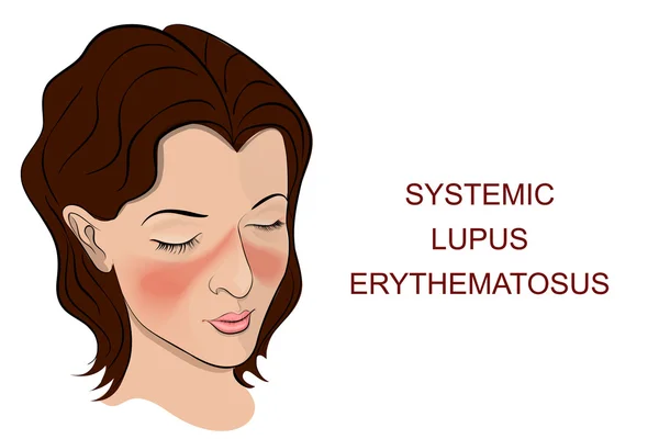 Szisztémás lupus erythematosus — Stock Vector