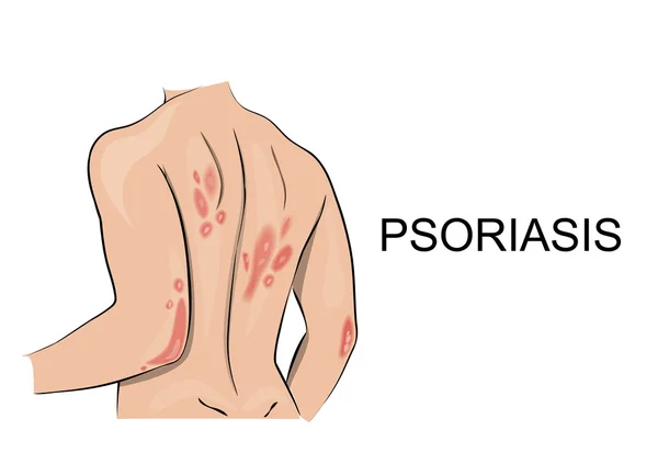 Psoriasis. Bőrgyógyászat. Allergia. — Stock Vector