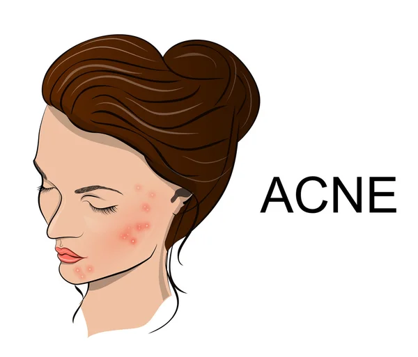 Illustratie van acne — Stockvector