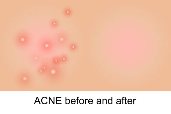Ilustración del acné — Vector de stock