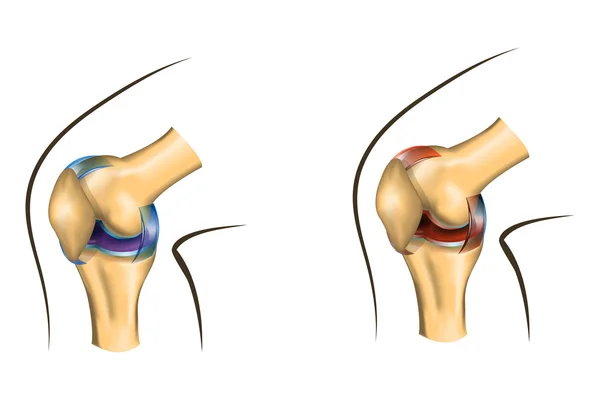 La articulación de la rodilla de sano y dañado — Archivo Imágenes Vectoriales