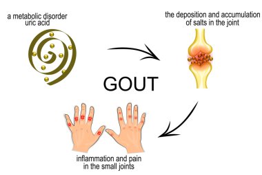 infographics for disease gout, podagra clipart