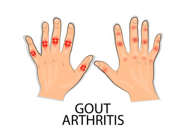 gut hastalığı için Infographics podagra
