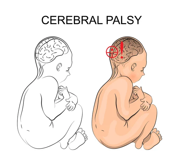 Parálisis cerebral. neurología — Archivo Imágenes Vectoriales