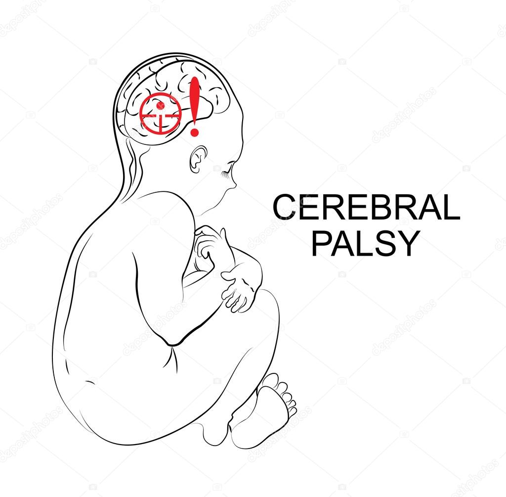 cerebral palsy. neurology