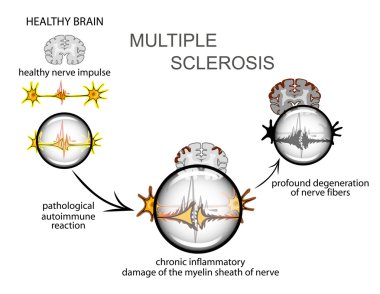 Multipl skleroz. Nöroloji