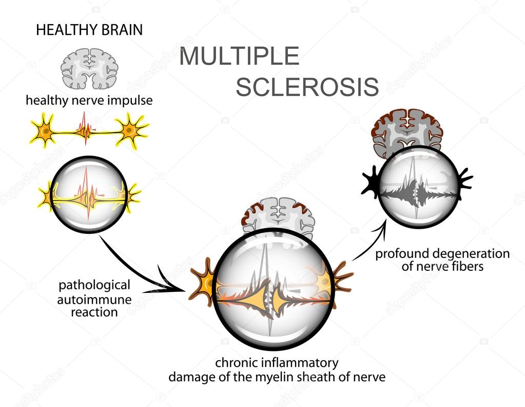 multiple sclerosis. Neurology