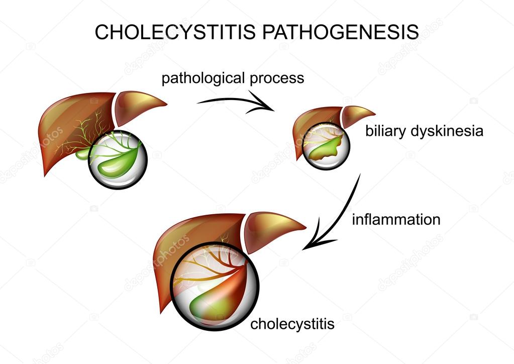 cholecystitis pathogenesis. pathogenesis