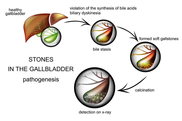 The pathogenesis of gallstones — Stock Vector