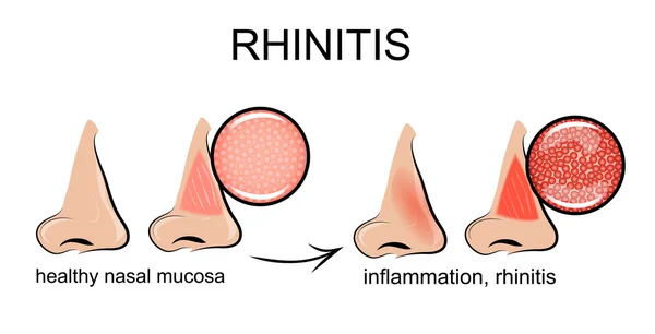 Inflammation de la muqueuse nasale — Image vectorielle
