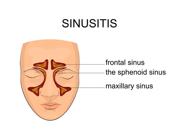 Seno nasal. inflamación — Vector de stock