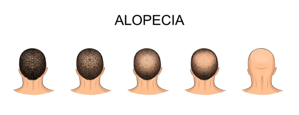 Homens s careca cabeça —  Vetores de Stock