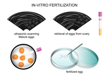 in vitro fertilization clipart