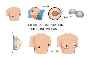Göğüs büyütme. Silikon implant