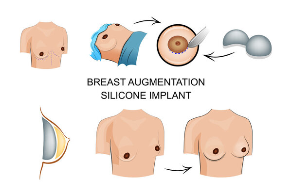 the breast augmentation. silicone implant