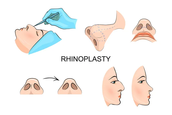 Nariz de plástico. cirurgia estética . — Vetor de Stock