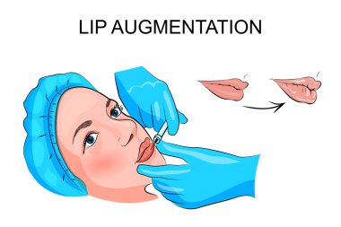 lip augmentation. injection clipart