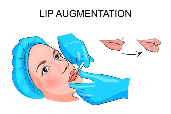 Augmentation des lèvres. injection — Image vectorielle