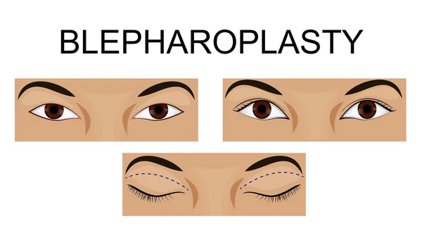 Upper eyelid blepharoplasty — Stock Vector