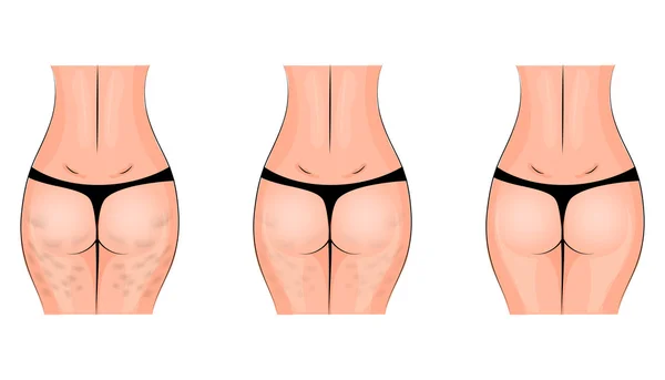 Cellulite, cellulite. fesses — Image vectorielle