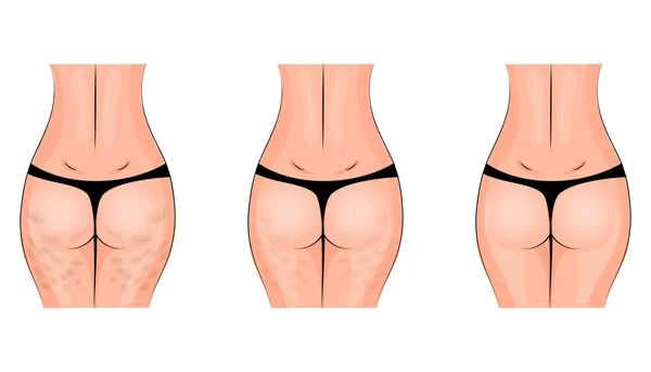 Celulitis, celulitis. nalgas — Vector de stock