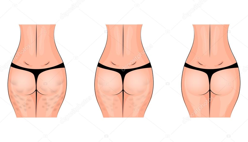 Cellulite, cellulitis. buttocks Stock Vector by ©Artemida-psy 95961120