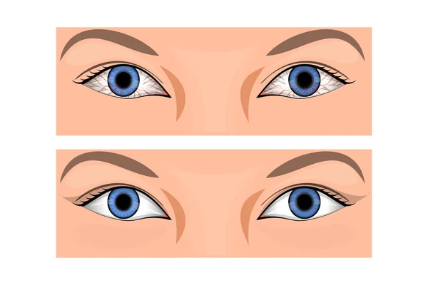 Enrojecimiento del ojo — Archivo Imágenes Vectoriales