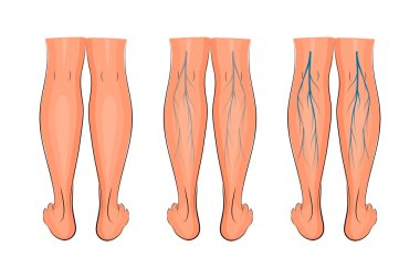 varicose veins of the lower extremities clipart