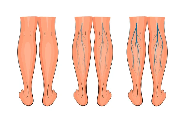 Spataderen van de onderste ledematen — Stockvector