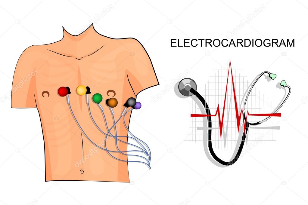 EKG, the patient with the electrodes on the chest. Stock Vector Image