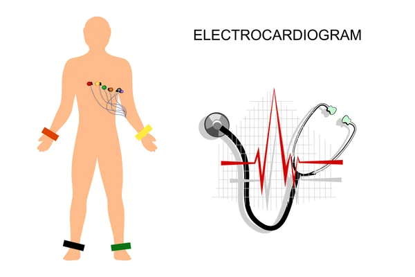 ECG, el paciente con los electrodos en el pecho . — Archivo Imágenes Vectoriales