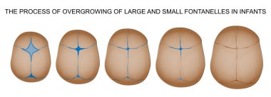 Fontanelle Yenidoğanlarda