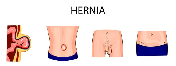 Hérnia umbilical e inguinal — Vetor de Stock