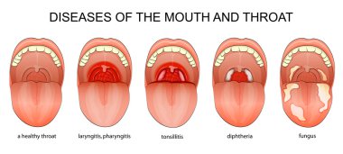 DISEASES OF THE THROAT clipart