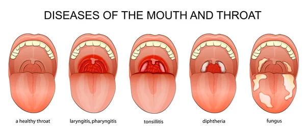 Ziekten van de keel — Stockvector