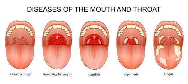 DISEASES OF THE THROAT