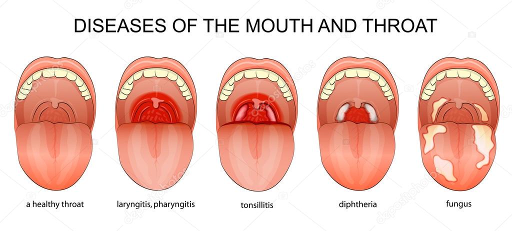 Normal Healthy Back Of Throat Pictures Luna Plutoniana