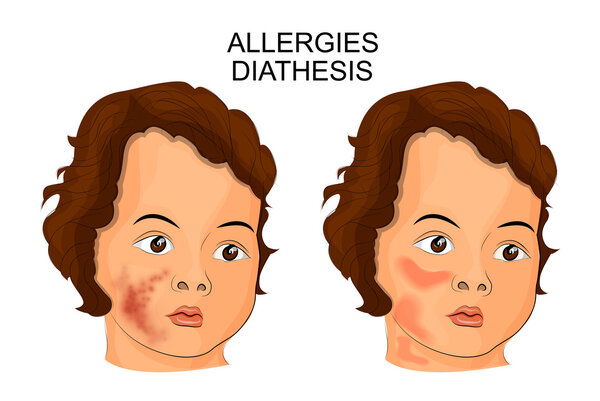 ALLERGIES, DIATHESIS. PEDIATRICS