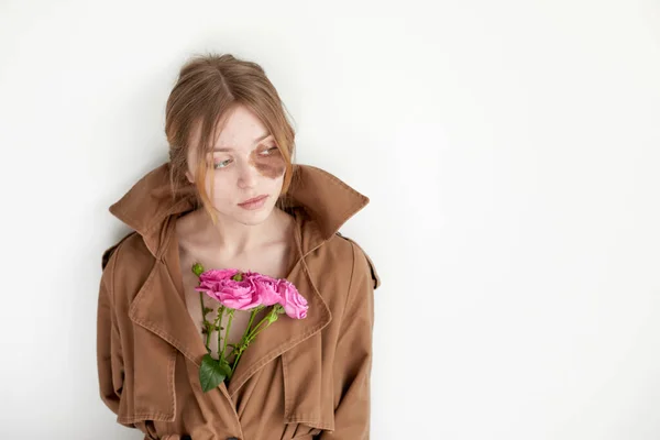 Žena s hyperpigmentací na obličeji s květinami — Stock fotografie