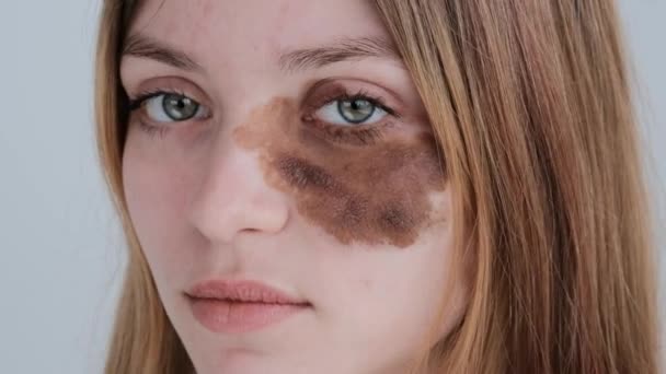 Mulher jovem com erupção cutânea sob o olho — Vídeo de Stock