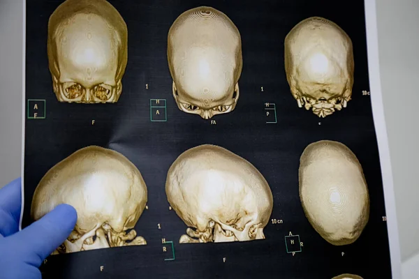 Τομογραφία Κρανίου Ανθρώπινο Κεφάλι — Φωτογραφία Αρχείου