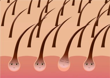 Kafa derisindeki çizgi film saç folikülleri kaybından muzdarip. Vektör illüstrasyonu