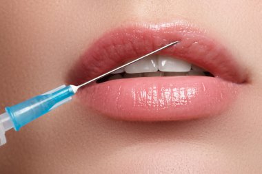Closeup of beautiful woman gets injection in her lips. Full lips. Beautiful face and the syringe (plastic surgery and cosmetic injection concept). Botox injections.