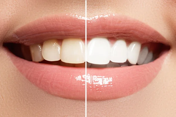 Dokonalý úsměv před a po bělení. Zubní péče a bělení zubů — Stock fotografie