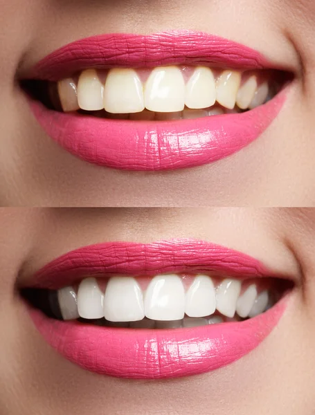 Tökéletes mosoly előtt és után fehérítő. Fogászati ellátás és fogfehérítés fogak — Stock Fotó