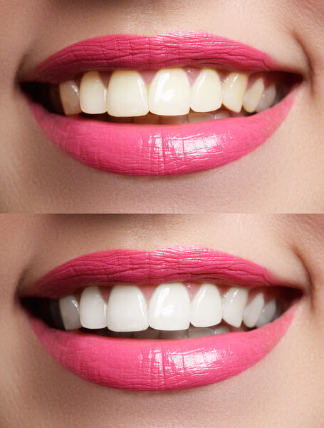 Perfect smile before and after bleaching. Dental care and whitening teeth