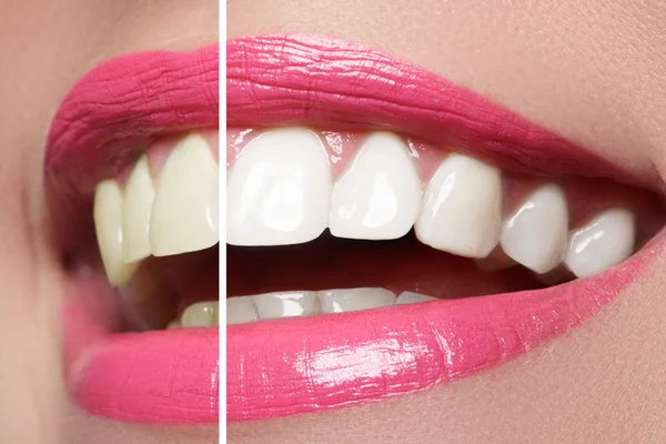 Perfect smile before and after bleaching. Dental care and whitening teeth. Pink lips. — Stock Photo, Image